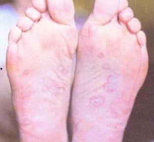 梅毒患者吃瓜,揭秘瓜果中的健康隐患