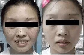 吃瓜女孩雀斑,揭秘娱乐圈的甜蜜与苦涩